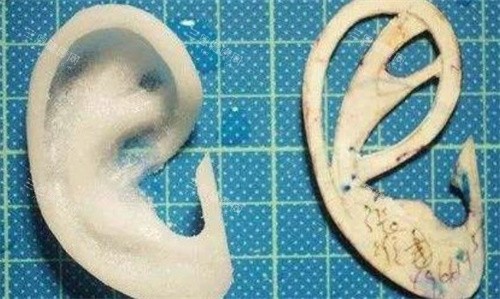 Medpor人工支架耳再造手术