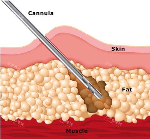 吸脂手术动画演示 吸脂手术动画演示