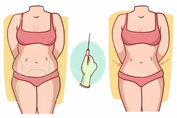 吸脂填充术 吸脂填充术