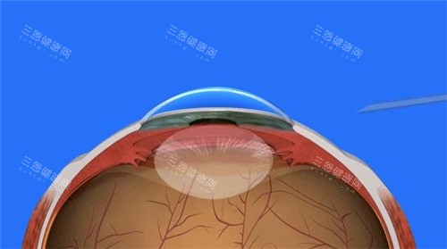 铁岭白内障手术可以免费吗？保险叠加救助，报销比例高可达90%，近乎免费！