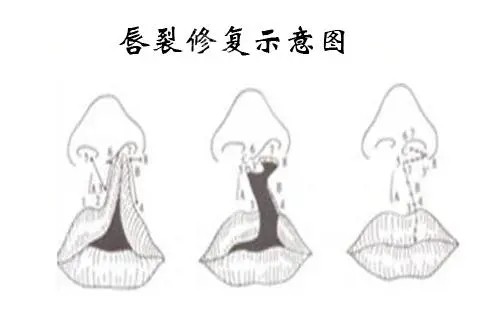 唇裂修复示意图.webp