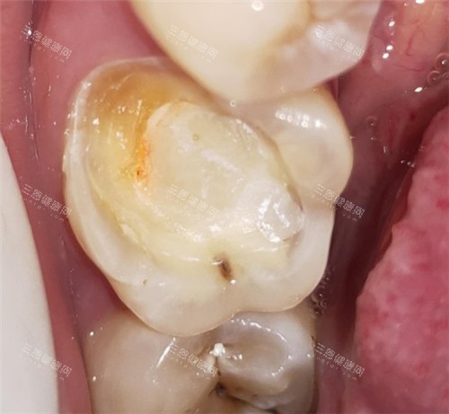 牙齿龋坏清理图