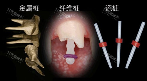 牙齿打桩材质