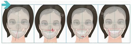 正颌手术手术步骤展示动画图