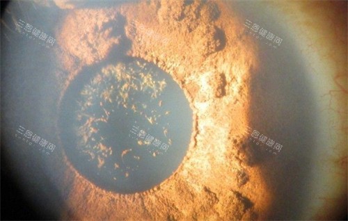 虹膜缺损病变