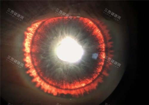 虹膜缺损的眼睛