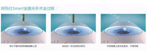 阿玛仕全激光手术全过程