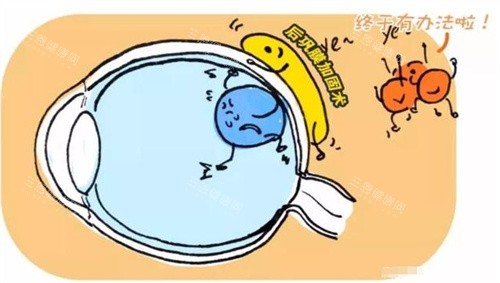 后巩膜加固术大概费用是多少？传统手术15000-25000元，小创口28000-45000元