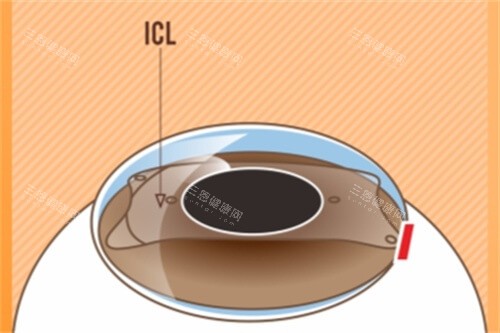 ​​ICL晶体植入术大概要多少钱？普通25000-35000元，散光30000-40000元