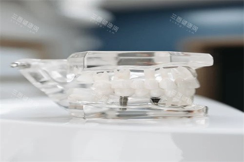 种植牙模型示意