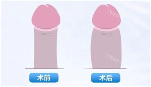 男性中途突然不举怎么治疗？常见误区与正确治疗手段解析，让你少走弯路