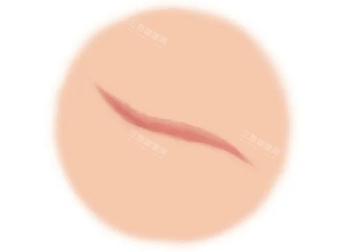 疤痕增生漫画示意图