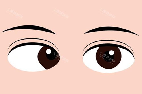 郑州中视眼科斜视手术怎么样?小创口10分钟|成人7000元起|复发率＜5%!
