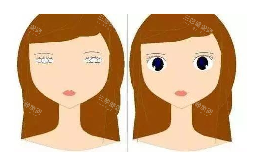 眼皮松弛做双眼皮对比图 眼皮松弛做双眼皮对比图