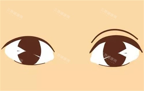 双眼皮手术的前后对比