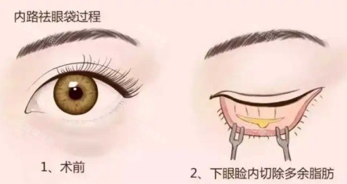 深圳市人民医院整形美容外科2025手术价格表：双眼皮3800+硅胶隆鼻9800+假体隆胸3.8w+