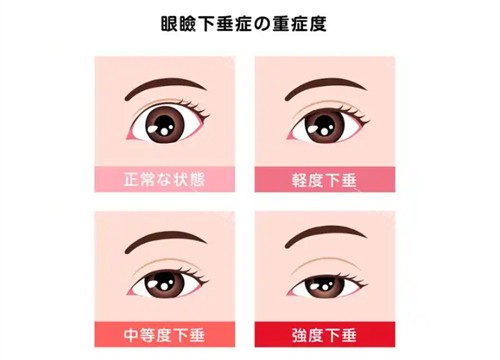 青岛灿辰波罗蜜白永辉上睑下垂不同程度的样子