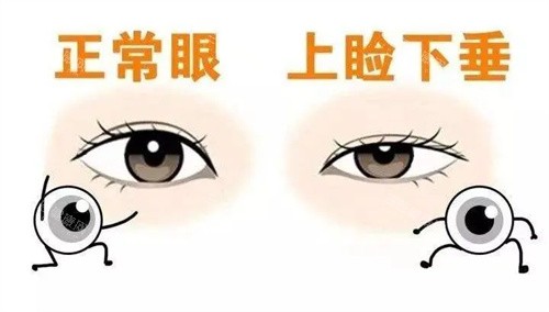 青岛灿辰波罗蜜白永辉正常眼和上睑下垂