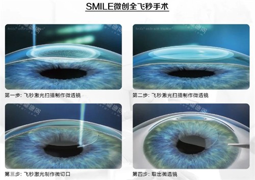 福州市第二医院眼科收费标准公布，近视手术9362元起/白内障4200元起！