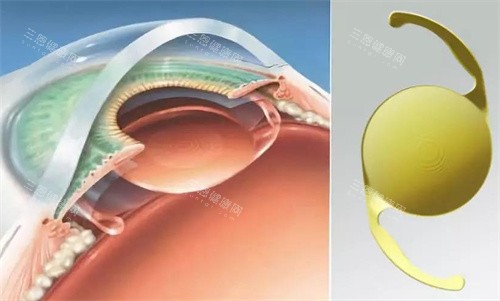 郑州尖峰眼科做白内障手术需要多少钱？3000元起，晶体植入4800元起，单/双/三焦点价格一览