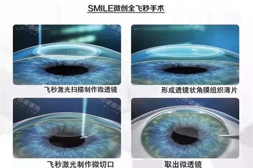 <span class='highlight'>微创</span>全飞秒手术过程示意图
