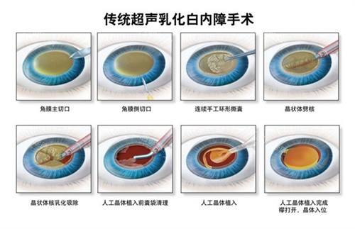 西安可以免费做白内障手术吗？当然可以！带上这些材料去社区登记申请免费名额！