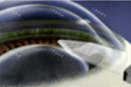 无锡二院眼科做晶体植入怎么样？1800度近视亲述：在这里做完晶体植入，终于摆脱啤酒瓶底眼镜！