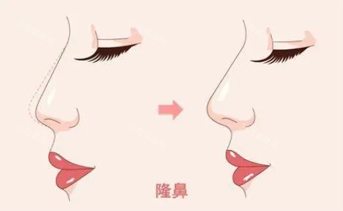 吴玉家做鼻子怎么样？榫卯结构+保留鼻技术，修复畸形鼻很成熟，整友口碑评价好