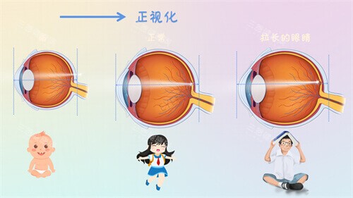 中山大学中山眼科中心近视手术哪个医生好？余克明擅 ICL 矫正高度近视，黄国富对散光等复杂病例有高招！
