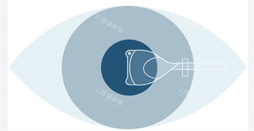 马志中医生做晶体植入手术怎么样？精密度高/手术时间短/改善快是他的技术特点！