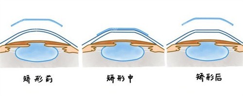 角膜塑形镜矫正原理