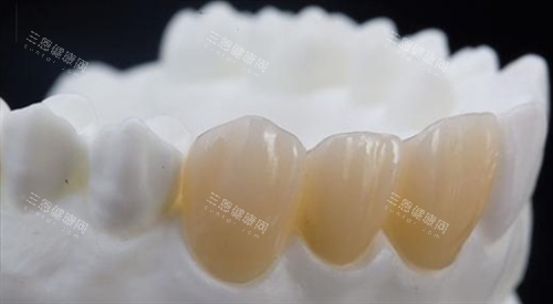 前牙全瓷冠展示