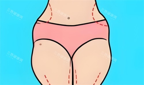 吸脂部位划线