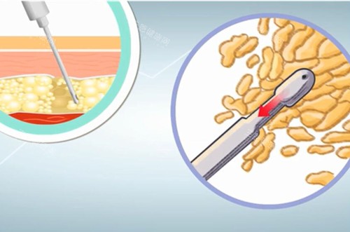 吸脂微观示意图 吸脂微观示意图