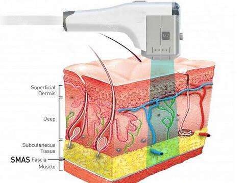 超声提拉操作原理