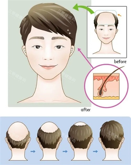 毛发种植手术前后对比