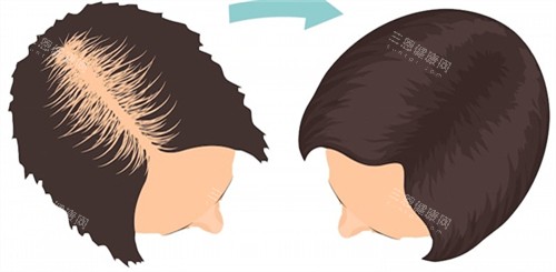 毛发种植前后对比
