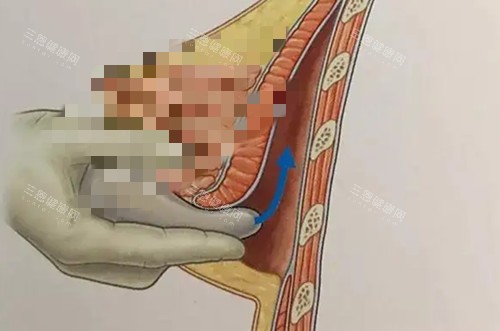 假体隆胸手术卡通示意图 假体隆胸手术卡通示意图