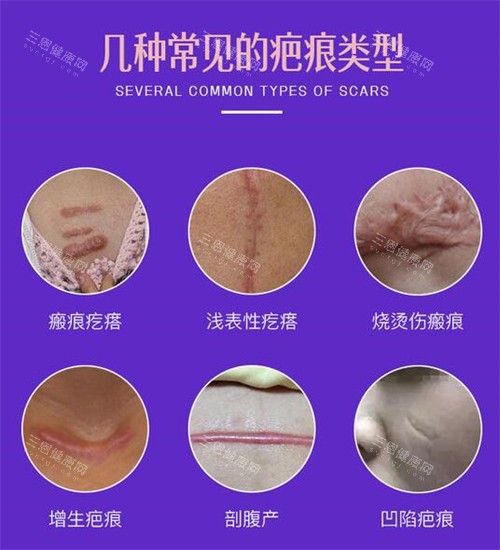 于艳菊祛疤需要多少钱？激光单次3800元起，YJ-7D联合疗法全程2-5万元起的收费内情已曝光！