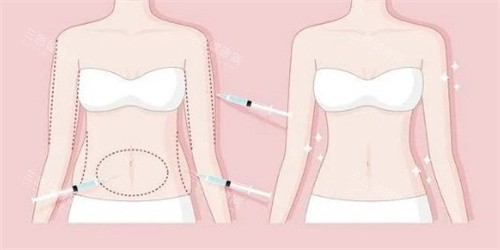 体雕价格一般是多少？不同部位和结果的价格差异全解析，帮你避坑！