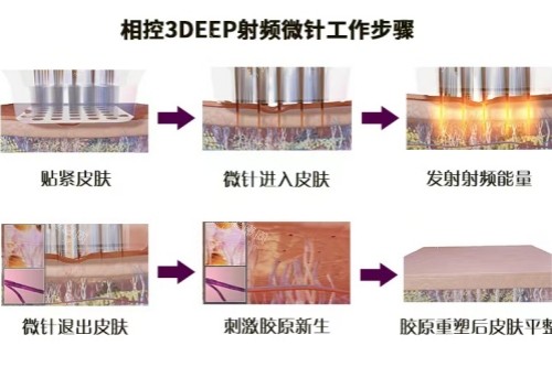 相控微针操作步骤图