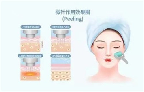 警惕！Endymed可能存在的副作用与危害，做之前这些风险你必须知道！