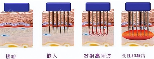 黄金微针操作过程