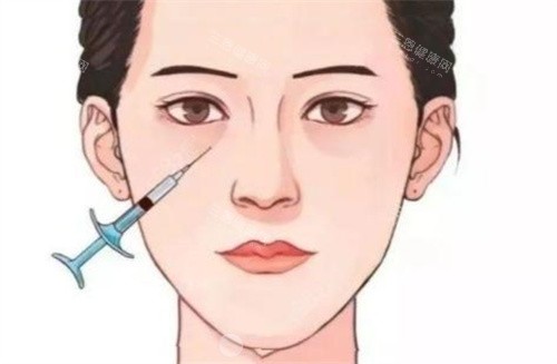 泪沟注射