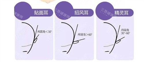贴面耳招风耳精灵耳区别