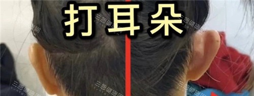 精灵耳注射图