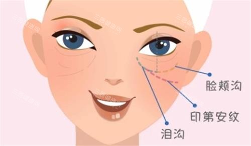 填泪沟怕出丁达尔？我选了双美胶原，术后眼周超自然