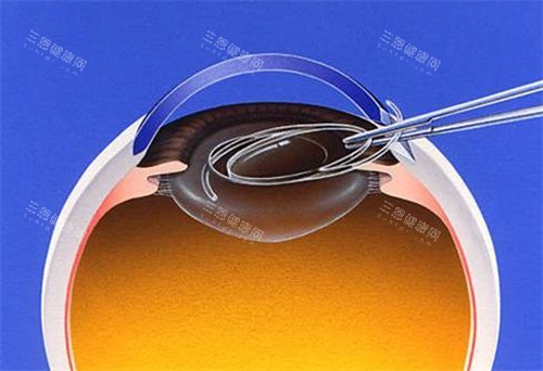 昆明白内障手术医院推荐:昆明眼科医院/昆明爱尔眼科医院/昆明华厦眼科技术对比!