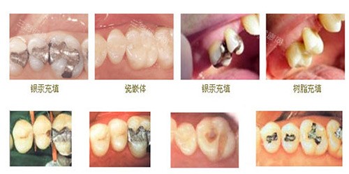 肿眼泡+上睑下垂救星！余海龙医生双眼皮术后1个月修复实录揭秘！