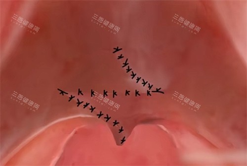 腭裂修复手术的缝合形状